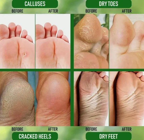 Urea 40% Heel Lotion with Pumice & Brush